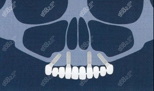 种植牙可以不做上颌窦提升吗