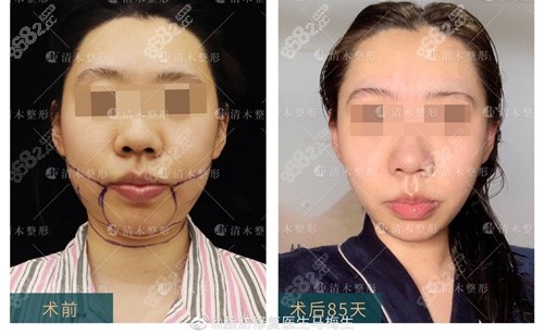 北京清木面部吸脂术前术后对比图