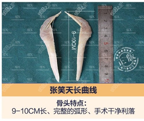 张笑天截骨图片