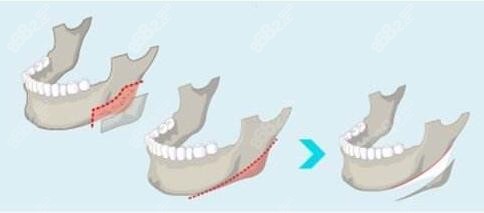 上海时光何晋龙3D下颌角手术