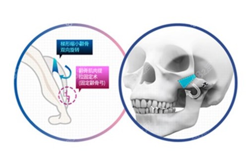 张笑天医生做颧骨内推手术