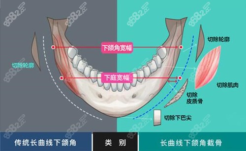 武汉中翰做下颌角的优势