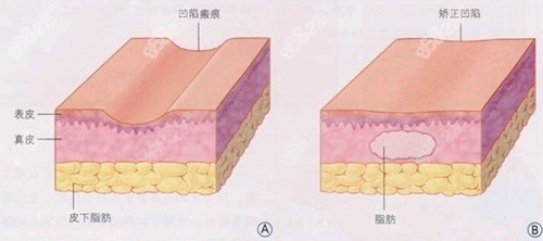 祛疤痕手术前后变化