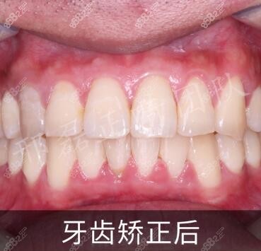 杭州瑞创口腔医院牙齿矫正术后