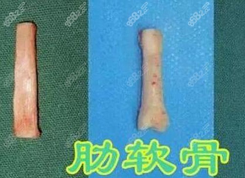 邓正辉做肋软骨鼻子的优势