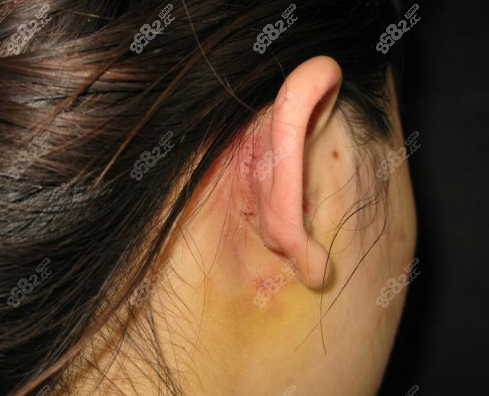 周蔚医生做耳软骨隆鼻的优势是采用耳后取软骨