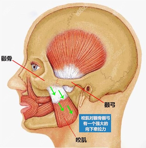 何照华张力带颧骨靠谱