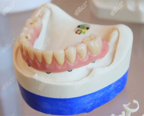 种植牙及牙冠修复体的价格