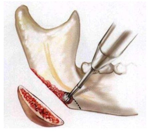 何晋龙做下颌角截骨手术