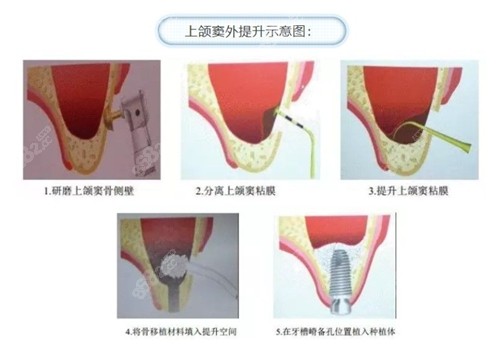 上颌窦提升手术原理