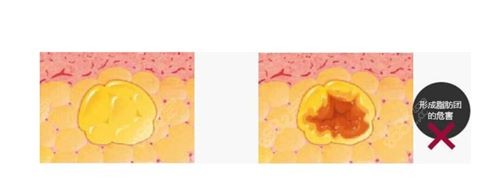 脂肪硬块结节