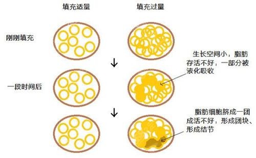 脂肪液化是什么意思图片