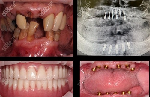 宜兴金铂利口腔全口种植牙例子