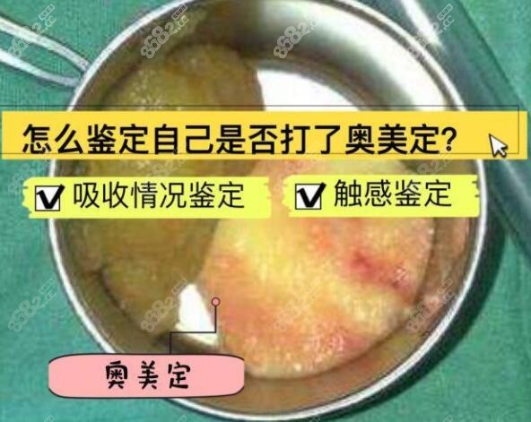 怎么鉴定自己是否打了奥美定