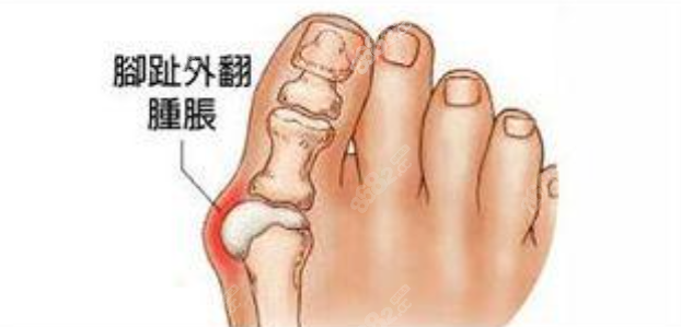 拇指骨头向外突出;北京圣嘉新出名的不仅是院内的颌面整形,还有大脚骨