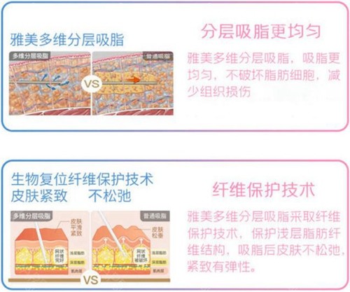 长沙雅美吸脂优势介绍