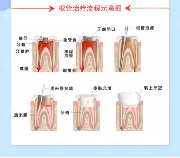 瑞创口腔根管治疗流程