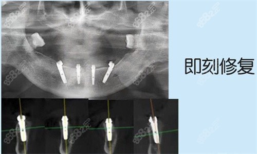 义乌种植牙口腔医院哪家好