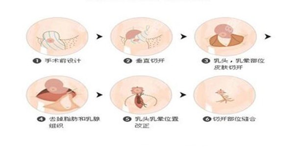 栗勇醫(yī)生做乳房縮小手術(shù)原理 