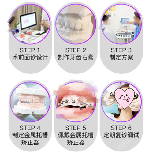 杭州美莱口腔矫正牙齿手法方法 过程图