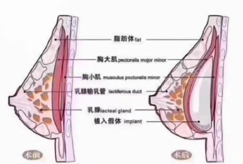 广州中家医家庭医生假体植入位置