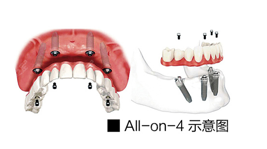 all-on-4半口种植牙优势