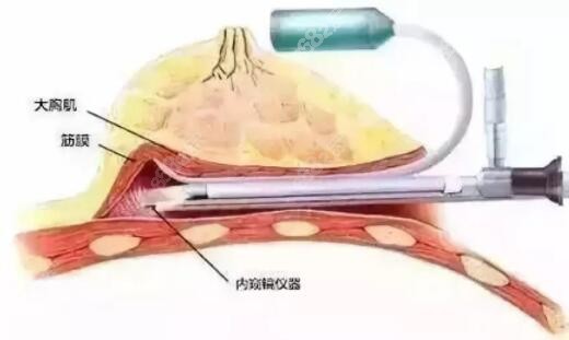 西安畫美內(nèi)窺鏡假體隆胸優(yōu)勢