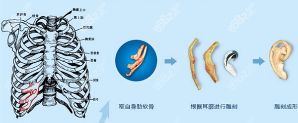 福建<!--<i data=20240705-sp></i>-->医生做耳再造手术