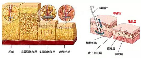 吸脂手术示意图