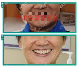 深圳登特口腔种植牙对比图