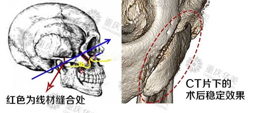 重慶華美潘寶華磨骨術(shù)后CT圖