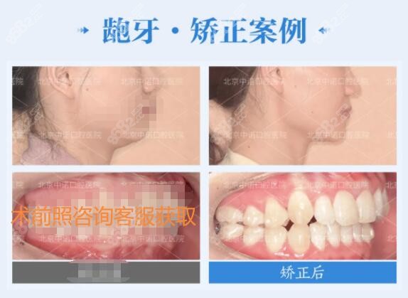 北京中诺牙齿矫正对比