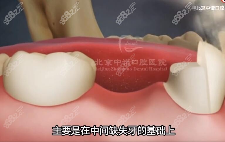 北京中诺牙齿种植好不好