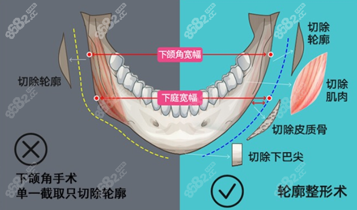 东篱医院轮廓手术示意图