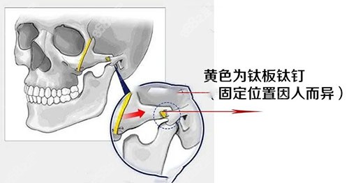 重慶華美潘寶華磨骨技術(shù)力