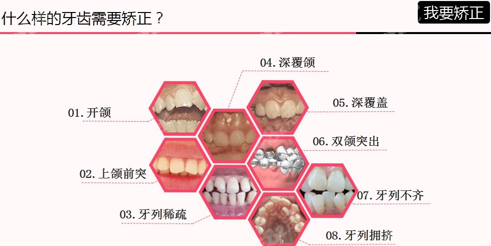 牙齿矫正适应症