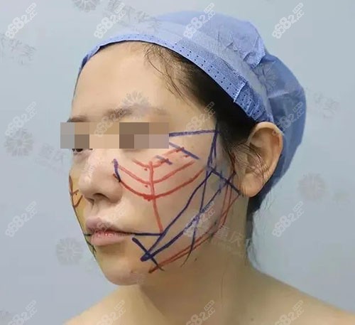 重慶華美潘寶華顴骨內(nèi)推審美力
