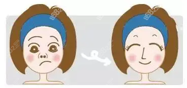 鼻整形前后对比图