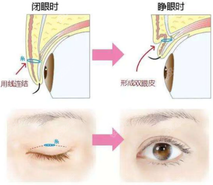 修复后重新设计双眼皮