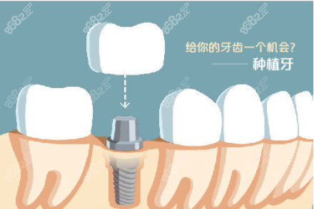 牙齿种植