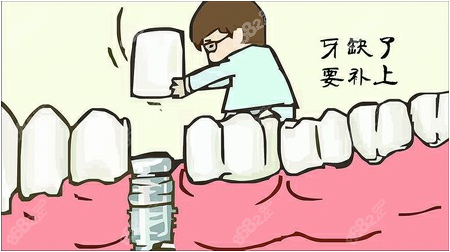 牙齿种植类型
