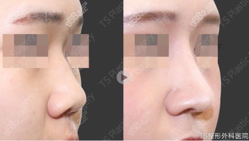 鼻小柱延长手术前后对比