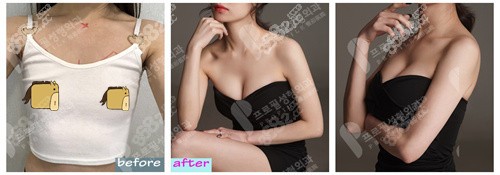 普羅菲耳隆胸前后對比圖