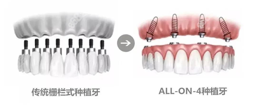 龙华区老人做半口种植牙多少钱