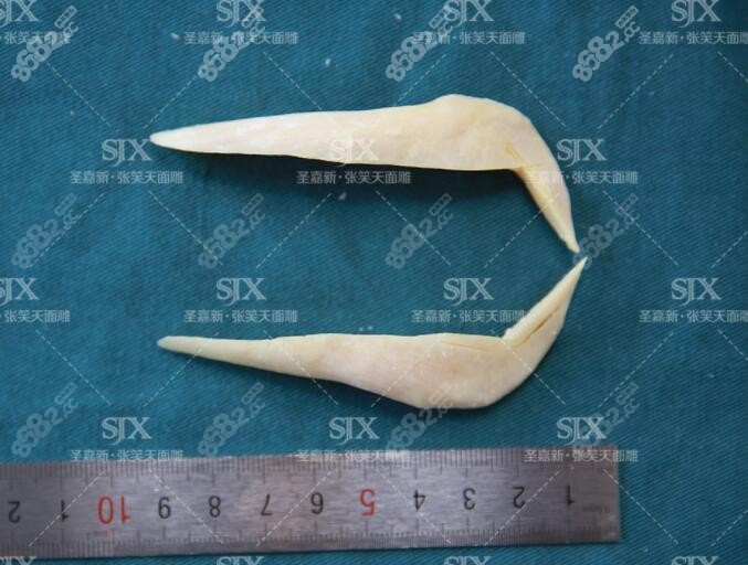 北京圣嘉新张笑天医生磨骨