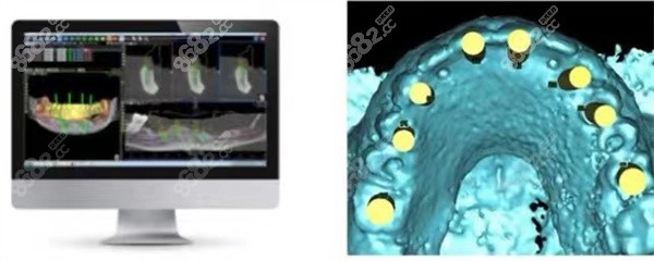 卡瓦ITU数字化无牙颌舒适种植牙