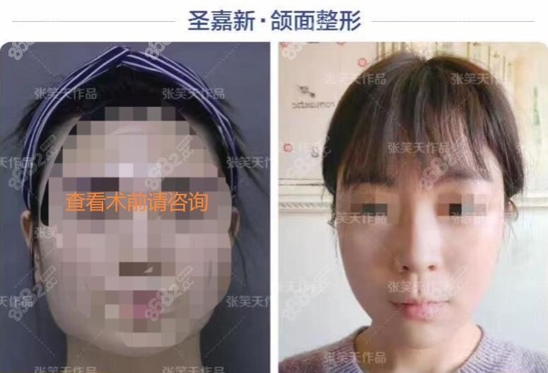 北京圣嘉新张笑天医生改脸对比
