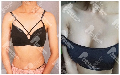 普羅菲耳假體隆胸前后對比照片