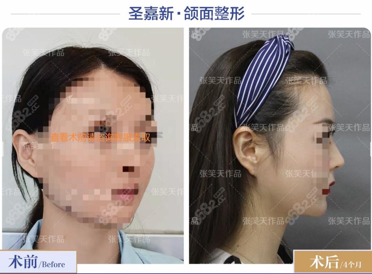 北京圣嘉新张笑天医生磨骨对比