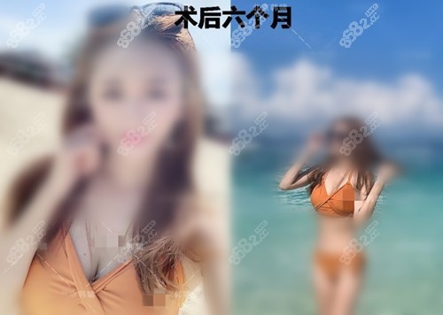 韩啸隆胸术后